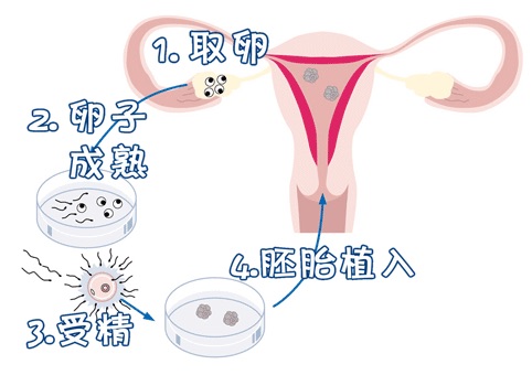 高龄二胎成功案例